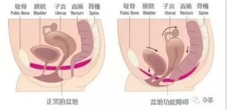 骨盆闭合与产后修复的区别（产后4个月做骨盆闭合后疼到跪地）(17)